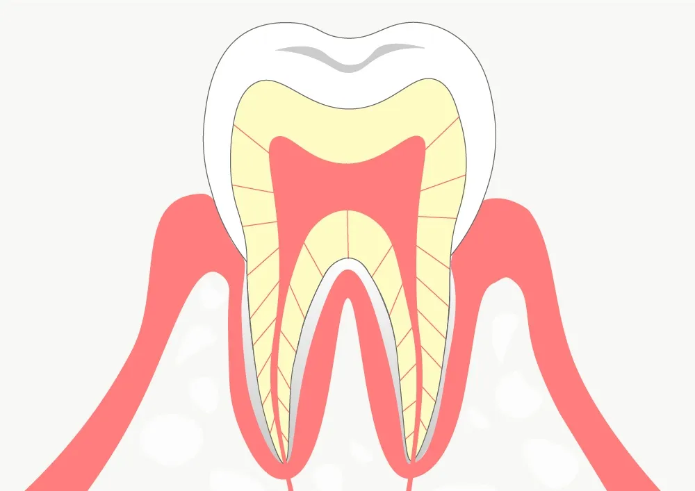 歯に穴が空く前の虫歯