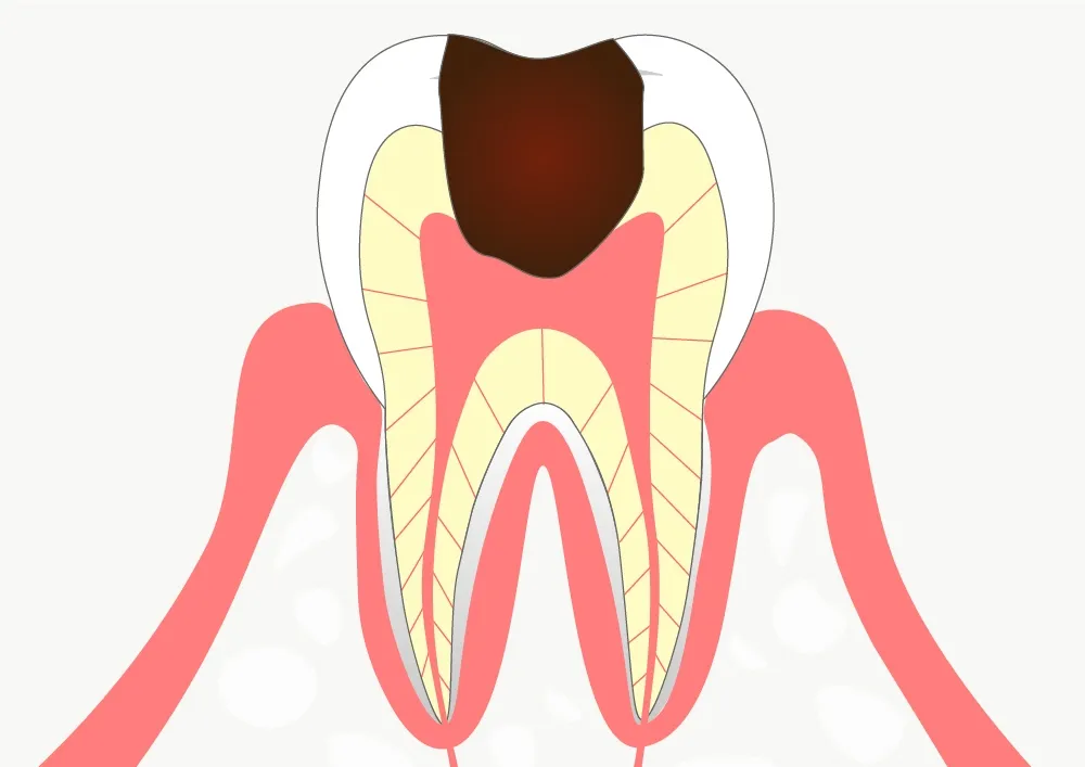 歯の表面の虫歯